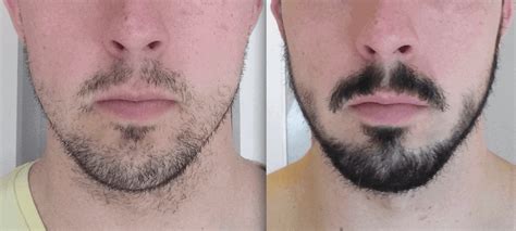 Rogaine For Beard Growth