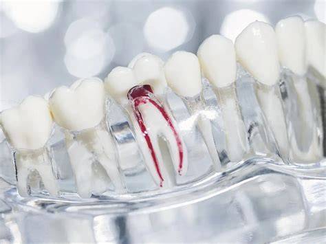 Root Canal Centennial