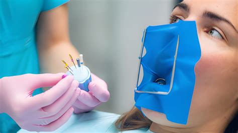 Root Canal Miami