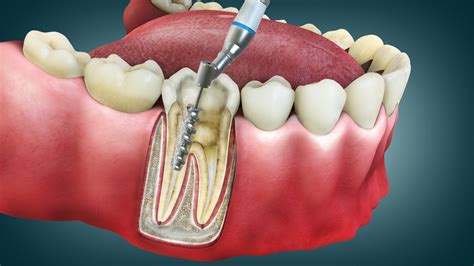 Root Canal Therapy Chicago