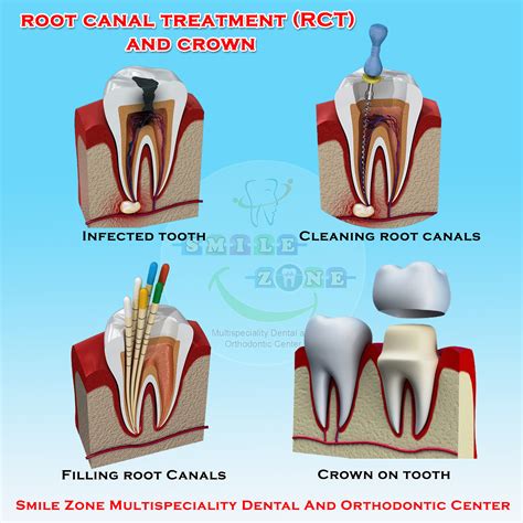 Root Canal Treatment RCT