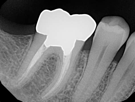Root Canal X Ray