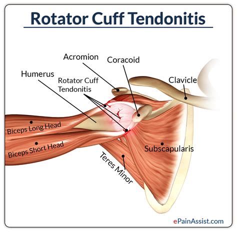 Rotator Cuff/Biceps Tendinosis Radiology Key
