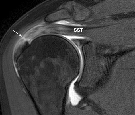Boston Shoulder Institute MRI rotator cuff tear