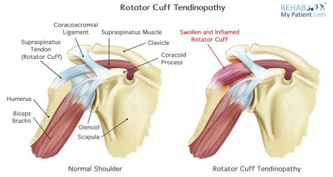 Rotator Cuff Tendinopathy and Tears