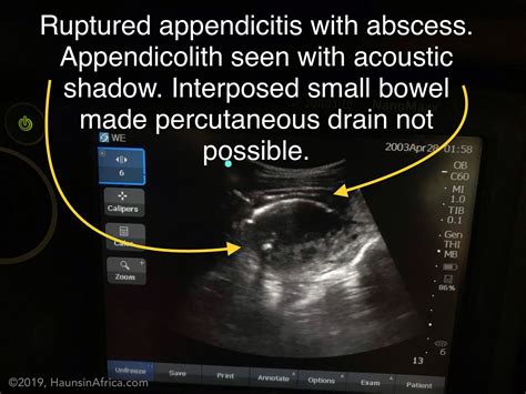 Acute appendicitis Image
