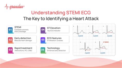 STEMI Heart Attack: Fast Facts & Action Steps