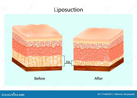 Firm up Your Look: Tackling Sagging Skin After Liposuction