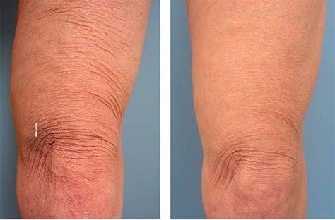 Say Goodbye to Sagging Skin on Your Legs with These Effective Tips