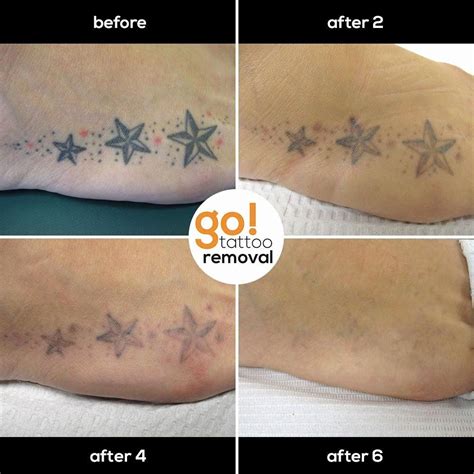 Salabrasion Home Tattoo Removal YouTube