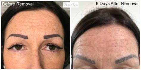 Botched Ink® Saline Tattoo Removal Before & After Results