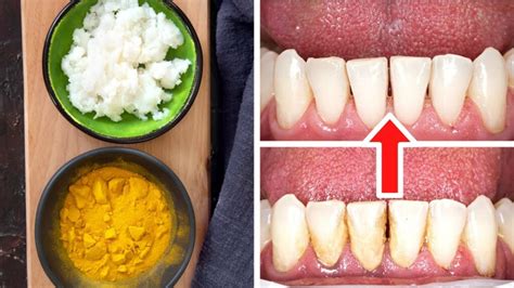 Salt: Effectively Remove Tartar & Freshen Breath