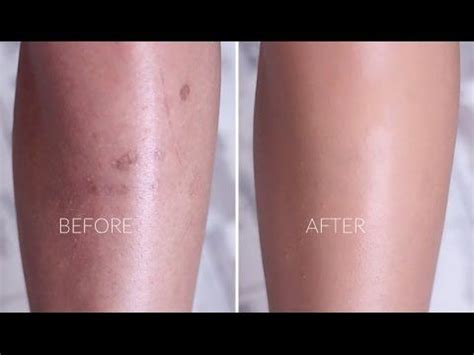 Scar Cover Up Makeup For Legs