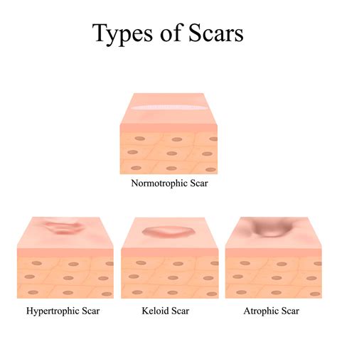 Scar Treatment: Types & Effective Solutions