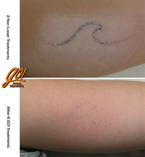 What to Do with Scarring After Laser Tattoo Removal