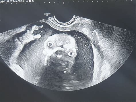Scary Ultrasound Images