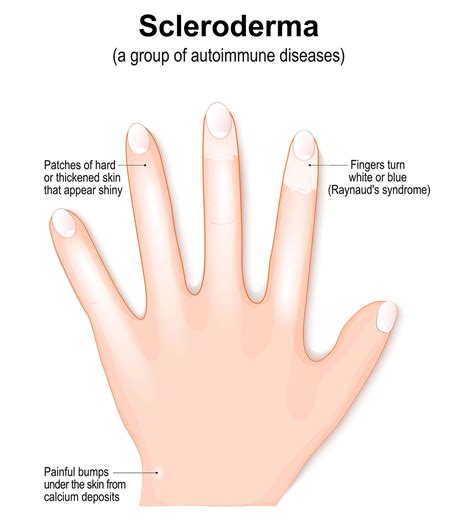 Scleroderma