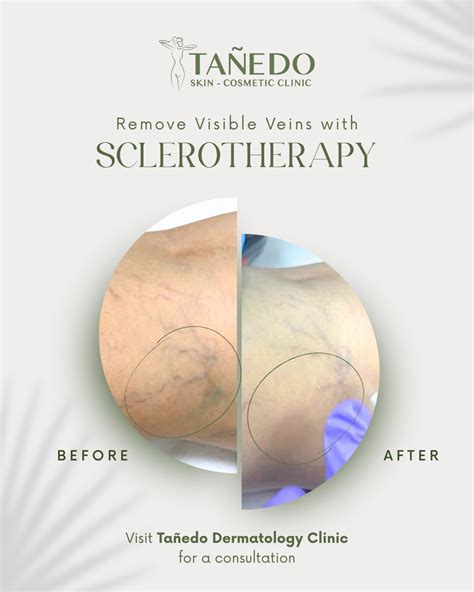 Sclerotherapy: Minimally Invasive Solution