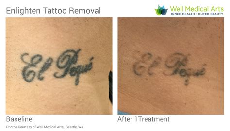 Tattoo Removal in Seattle using Pico Technology at Well