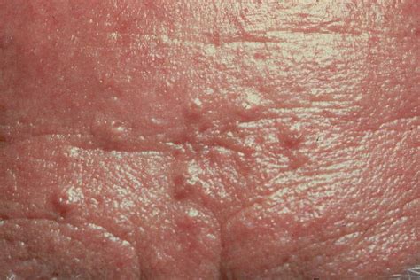 Sebaceous Adenomas