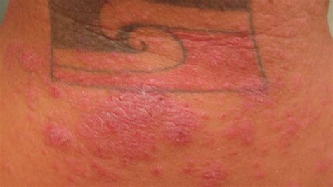 second skin tattoo bandage rash Augusta Lovett