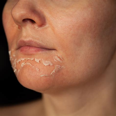 Farewell to Premature Peeling: The Ultimate Guide to Delaying Second Skin Shedding