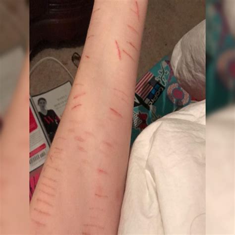 Self Harm Image