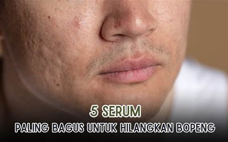 Serum Paling Bagus Untuk Menghilangkan Bekas Jerawat