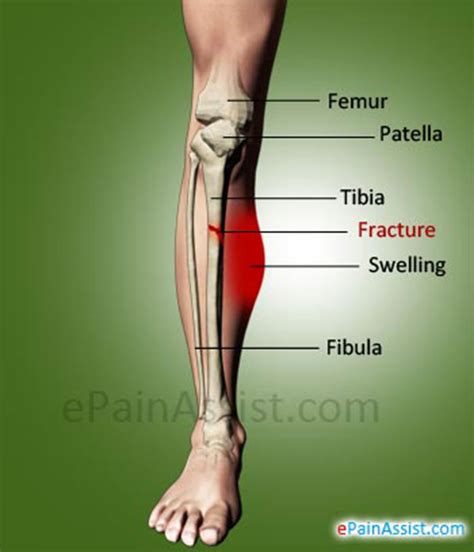 Shin Bones: Function, Injuries & Recovery Tips