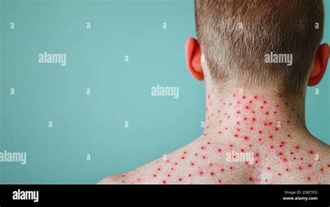 Shingles Rash: Identifying the Visual Indicators