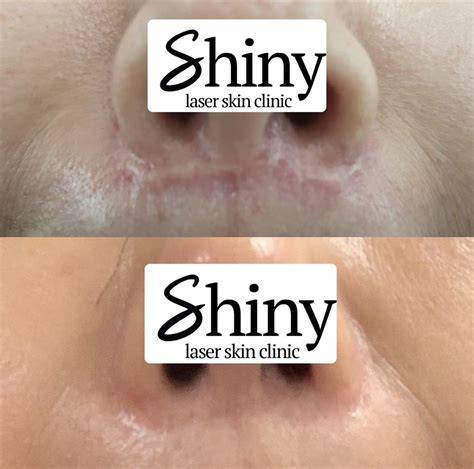 Get the Radiant, Flawless Skin You Deserve with Shiny Laser Skin Clinic