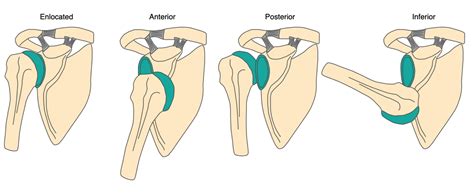 Shoulder Dislocation Gymnastics