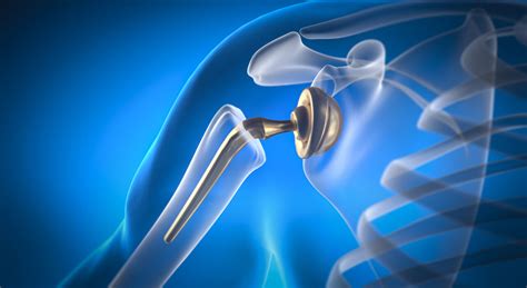Shoulder Replacement Surgery: Relieve Chronic Pain