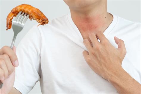 Shrimp Allergy Relief: Fast First Aid Tips