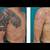 Side Effects Of Laser Tattoo Removal