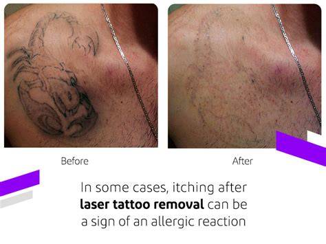 Side Effect Of Tattoo Removal