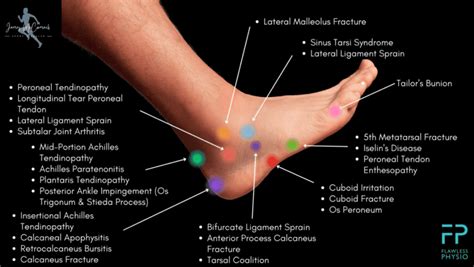 Side Foot Pain Chart
