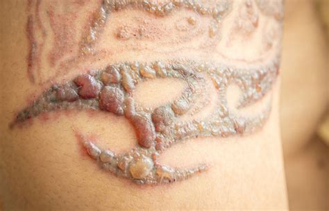 Signs Of Over Moisturized Tattoo