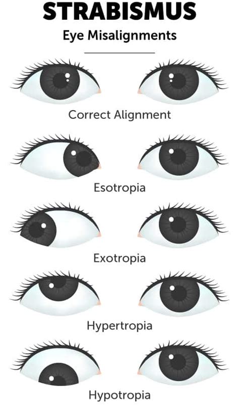 Signs You Might Have Eye Misalignment