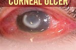Signs of Corneal Ulcer
