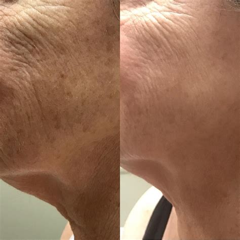 Simply Skin Laser Medispa - Unveiling a New You with the Magic of Laser Technology