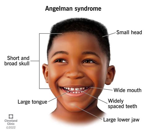 Angelman Syndrome What Is Angelman Syndrome?
