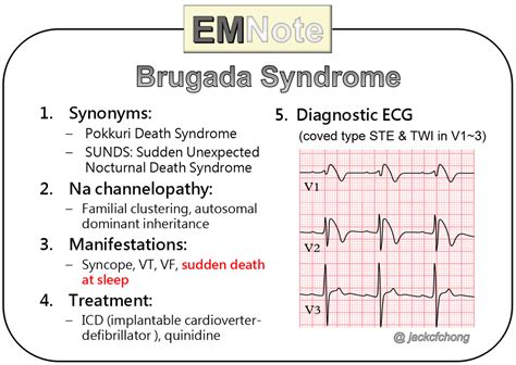 FileBrugada syndrome type1 example4.png ECGpedia