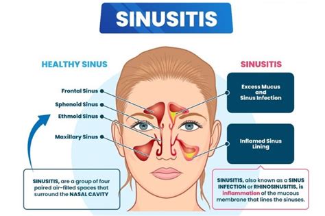 Sinus Issues and Referred Pain