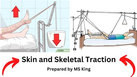 Skeletal Vs Skin Traction: Understanding the Differences and Benefits