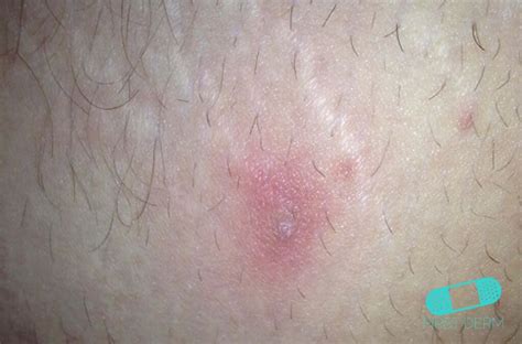 Banish the Pain and Suffering: Discover Effective Care for Skin Abscess with These Vital ICD-10 Keywords!