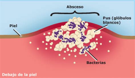 Suffering from a Skin Abscess in Spanish? Unleash the Ultimate Guide for Relief!