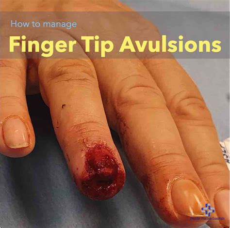 Skin Avulsion Icd 10