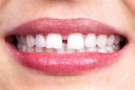 Say Goodbye to Tooth Gap Woes: A Guide to Healthy Skin Between Front Teeth
