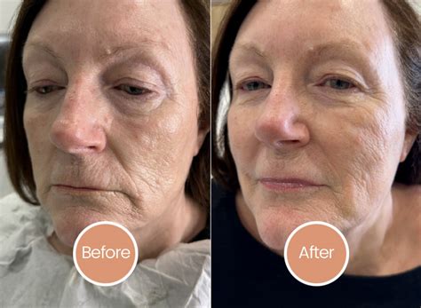 Unlocking Radiant Skin: Transformative Skin Booster Injections - Jaw-Dropping Before and After Results!